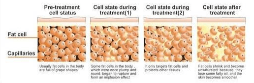 how to rupture fat cells)
