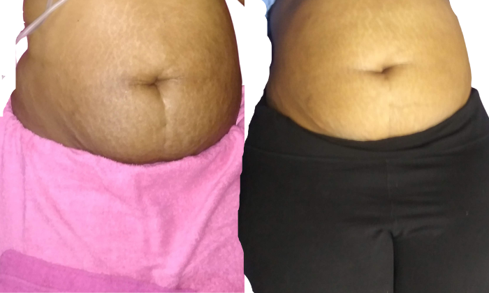 Scar and Stretch Mark Reduction