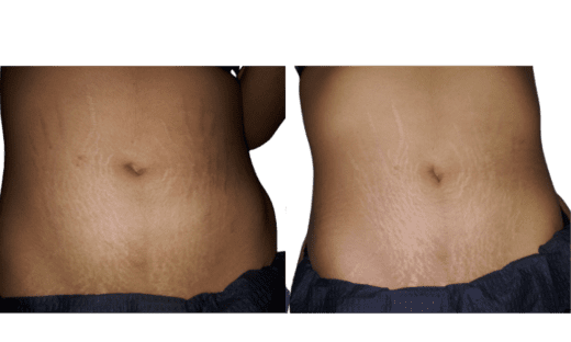 Skin Tightening and Stretch Mark Reduction