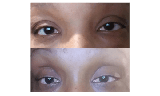 Skin Tightening-Eye Lift